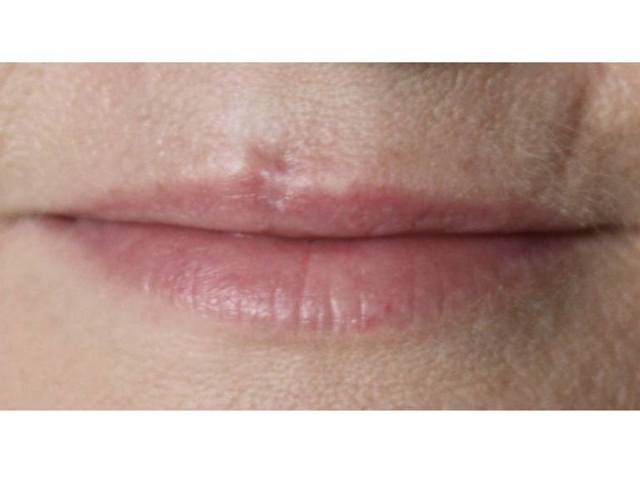 Шрам від пірсингу губи: фото і як позбутися?