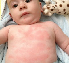 Алергія у новонароджених і у дітей старшого віку: причини, групи, види, лікування, профілактика