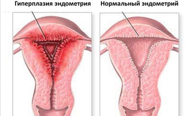 Якою має бути товщина ендометрію при вагітності