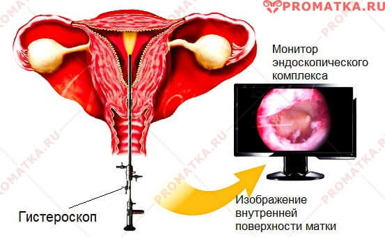 Особливості вишкрібання порожнини матки при гіперплазії ендометрія