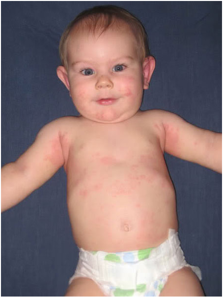 Алергія на глютен у грудничка і дітей старшого віку: 6 методів діагностики, 4 варіанти лікування, дієта