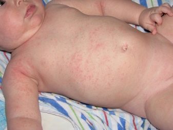 Як відрізнити пітницю від алергії у немовляти: 13 відмінностей, симптоми, поради по догляду за шкірою дітей