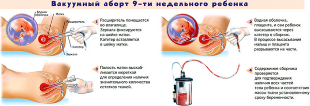 Виділення після вакуумного переривання вагітності: норма і патологія