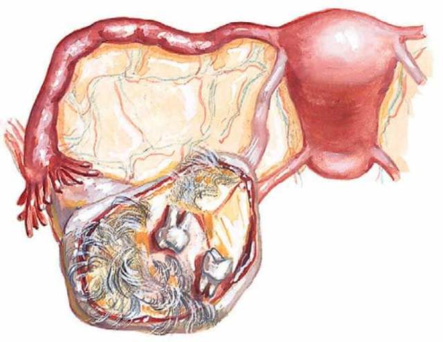 Все про дермоидной кісті яєчника: лікування, причини, симптоми