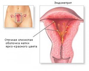 Чи можна завагітніти при хронічному ендометриті