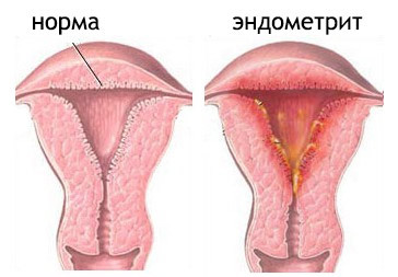 Відмінності між ендометритом і ендометріоз