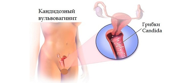 Чому з'являються коричневі виділення після менструації