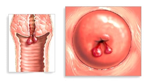 Причини виникнення і методи лікування поліпа цервікального каналу при вагітності