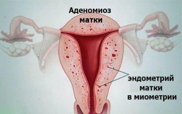 Чи можна завагітніти з аденоміозом