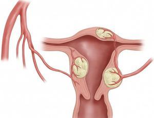 Чому почалися кров'янисті виділення після менструації