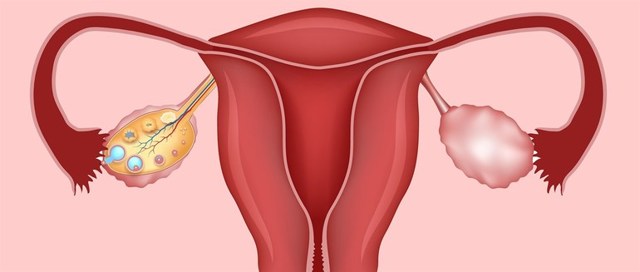 Застосування свічок від вагінальних виділень: огляд ефективних засобів