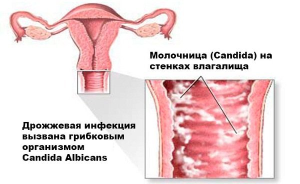 Як лікувати молочницю при вагітності і грудному вигодовуванні: ефективні поради та препарати