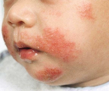 Алергічний висип у дітей: причини і 8 факторів ризику, види, 13 методів лікування, огляд препаратів