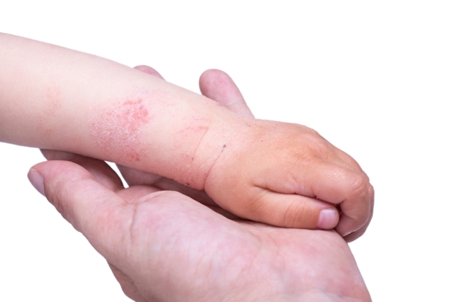 Алергічний висип у дітей: причини і 8 факторів ризику, види, 13 методів лікування, огляд препаратів