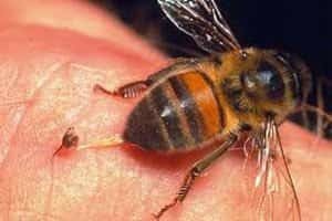 Перша допомога при укусі бджоли дитині: 4 ступеня тяжкості, 10 рекомендацій лікаря