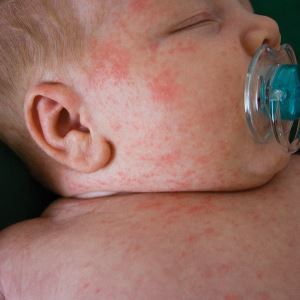 Алергія на порошок у дитини: як проявляється, 6 факторів ризику і 4 основних алергену