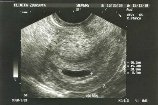 8 3 недели беременности. УЗИ 8 недель беременности гипертонус. Тонус матки на УЗИ 8 недель. Снимок УЗИ беременности на ранних сроках.
