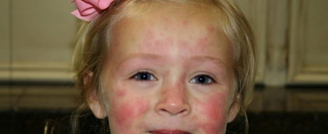 Алергія на сонце у дітей: 5 факторів, 4 ознаки, перша допомога