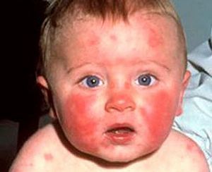 Алергія на сонце у дітей: 5 факторів, 4 ознаки, перша допомога