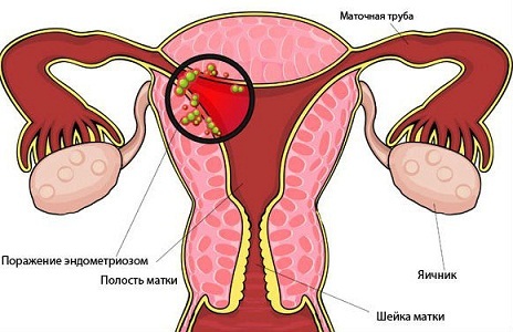 Які бувають виділення в період менопаузи
