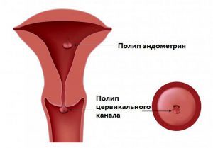 Причини виникнення і методи лікування поліпа цервікального каналу при вагітності