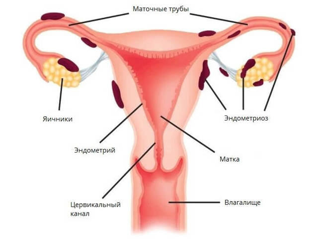 Небезпечні наслідки невилікуваного ендометріозу матки