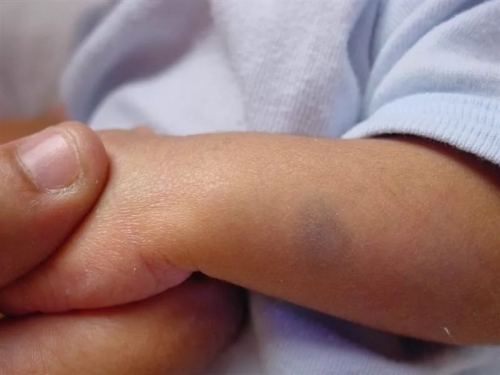 Шкірні захворювання у новонароджених: 7 проявів, що робити, догляд за шкірою