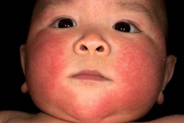 Як відрізнити пітницю від алергії у немовляти: 13 відмінностей, симптоми, поради по догляду за шкірою дітей