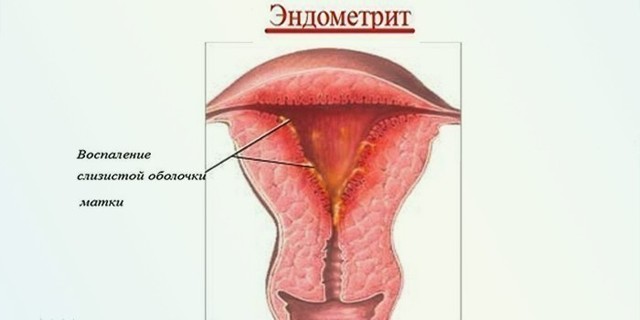 Як виявити і вилікувати хронічний ендометрит
