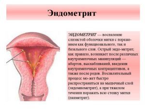 Якими бувають виділення при ендометріозі