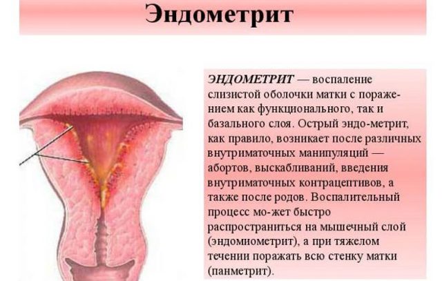 Препарати для лікування ендометриту у жінок