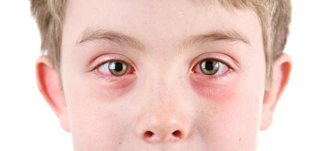 Алергічний кон'юнктивіт у дітей: 7 основних причин і 5 способів лікування