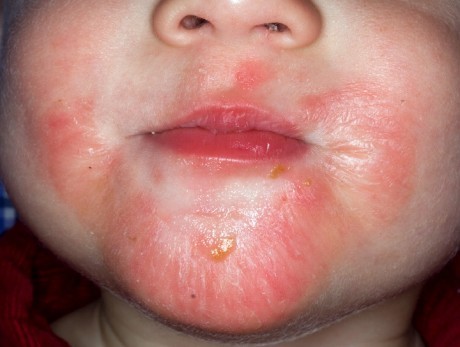 Дерматит у дитини: 4 основних види дерматиту у дітей і огляд найефективніших лікарських засобів