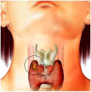 Кісти щитовидної залози.  Причини і лікування