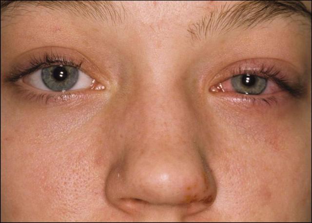 Як визначити на що виникла алергія, відмінності алергії та ГРВІ