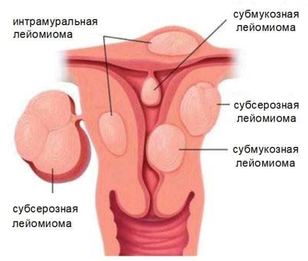 Операция по удалению миомы матки