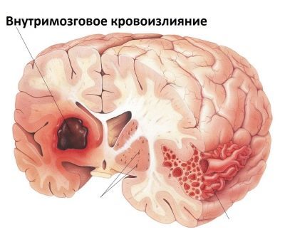 Кіста головного мозку у новонародженого