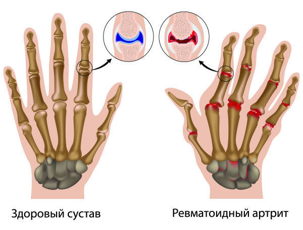 Ревматоїдний артрит пальців рук, перші симптоми