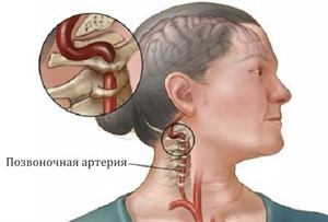 Синдром хребетної артерії при шийному остеохондрозі і його симптоми