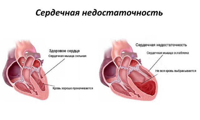 Кашель при серцевій недостатності: симптоми і методи лікування