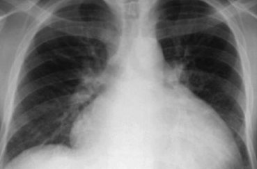 Рентгенографія грудної клітки: показання та протипоказання