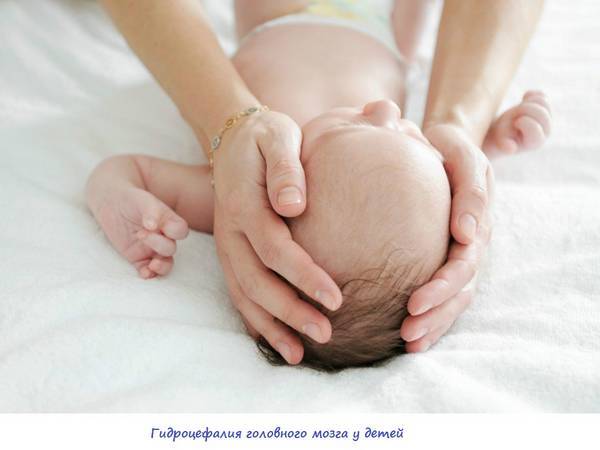 Симптоми і лікування гідроцефалії головного мозку у дітей