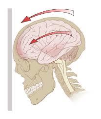 Ознаки струсу мозку у дорослої людини