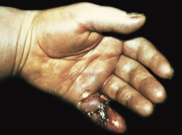 Способи лікування панарицію пальця на руці