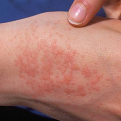 Симптоми і способи лікування алергії на холод