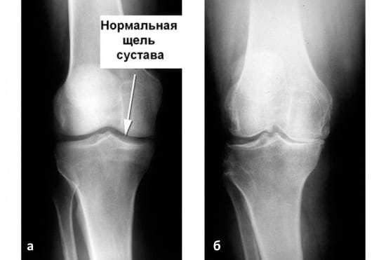 Остеоартроз коленного сустава 1 степени: лечение