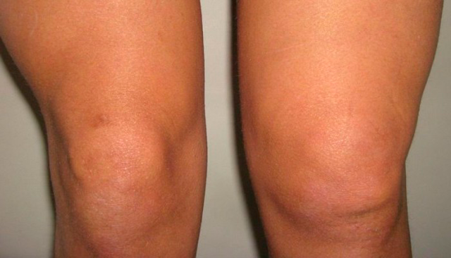 Бурсит колінного суглоба: симптоми і лікування