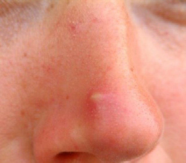 Прищі на носі: причини появи, лікування та профілактика
