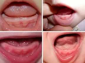 Симптоми прорізування зубів у немовлят