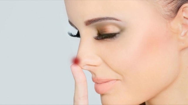 Прыщи на носу: причины появления, лечение и профилактика